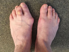 Hallus valgus, la bosse sur le pied qui se trouve sur la gauche
