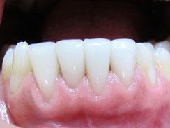 Veneers der unteren vier Schneidezähne (Aufnahme 4 Jahre nach dem Einsetzen): Das Zahnfleisch ist hell rosa und gesund.