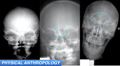 Anthropologists Devise New Tool For Estimating Juvenile Age at Death