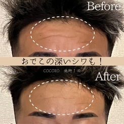 頭蓋骨矯正　ビフォーアフター