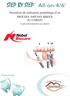 Step by Step, All on 4, Nobel Biocare, édentement total, implantologie, redonner le sourire.