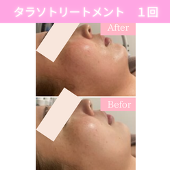 リアボーテ　ビフォーアフター