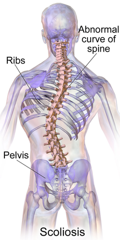 Scoliosis=側弯症