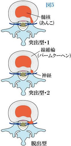 椎間板ヘルニアのタイプ