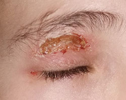 eczema paupiere avec des croutes