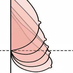 Bruststraffung Grafik