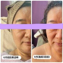 施術1~3回目プレミアムフェイシャル、3回目のみ+石膏パック