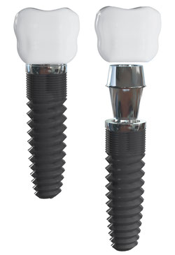 Dental Implant Gresham