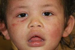 eczema severe visage