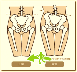 歪んだ骨盤を矯正していきます