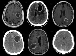 癌の治療後に発見される事がある転移性脳腫瘍