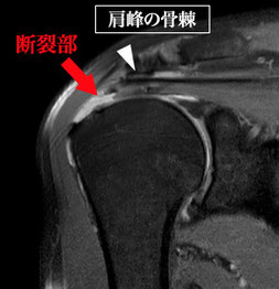 腱板断裂、千葉、柏、MRI、名戸ヶ谷病院、関節治療センター、整形外科、関節鏡下腱板修復術、ARCR