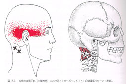 後頭下筋群のトリガーポイント