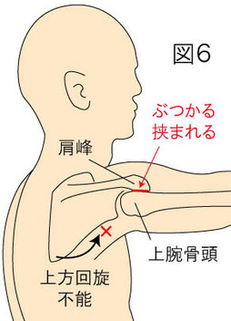 肩峰下インピンジメント症候群