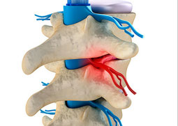 sciatica