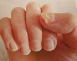 Gelbliche Verfärbung, ein Anzeichen für Nagelpilz