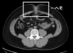 CT画像　自分のお腹