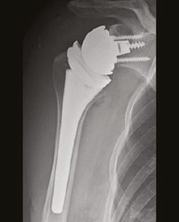 Orthopraxis Schwarzenbek - Röntgenbild Schulterprothese