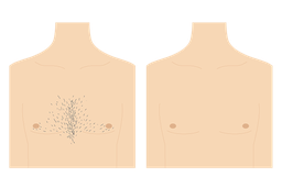 胸毛 腹毛 脱毛　福岡