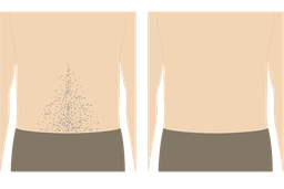 背中のムダ毛 腰毛　メンズ脱毛 福岡