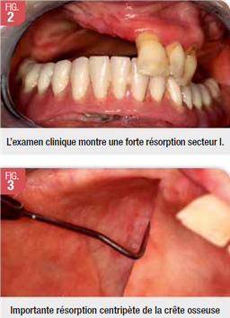 L'extraction dentaire – préservation osseuse avant la mise en place d'un  implant dentaire Le Perreux sur Marne (94170)