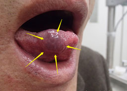 舌のできもの　血管腫