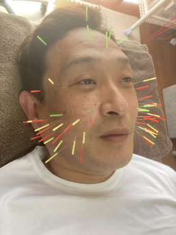 小牧 鍼灸 はり 治療 美容鍼 腰痛 坐骨神経痛 自律神経 頭痛 めまい 過敏性腸症候群 下痢 便秘 食欲不振