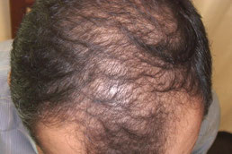 Diffuser Haarausfall - Alopecia diffusa (Quelle: https://www.dr-ruemmelein.ch/angebot/allg-dermatologie/haarausfall)