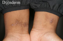 eczema lichenifie frottement ourlet 