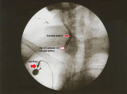 Röntgenbild eines arteriellen Katheters, der in die rechte Halsschlagader eingeführt wird, mit Markierungen für die Arterie und die Katheterspitze.