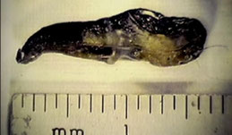 Implant extraterrestre