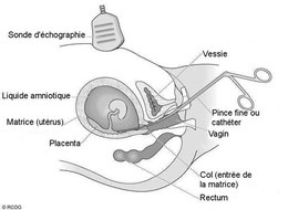 voie vaginale