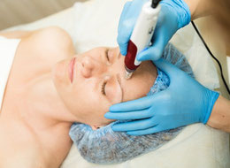 microneedling Behandlung