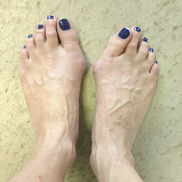 Hallux Valgus ganzheitliche behandlung