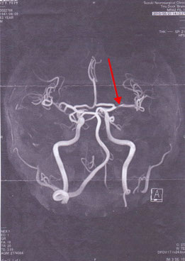 S脳神経外科のMRA画像