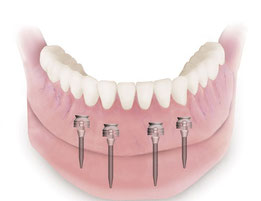 Modelldarstellung von 4 Miniimplantaten im Unterkiefer mit dazugehöriger Totalen Prothese