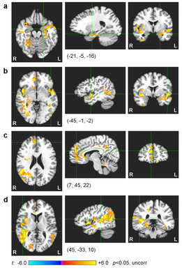 Fig. 5. Imágenes de RMF de un grupo de personas sanas después de entrenar de forma simultánea con neurofeedback y RMF.