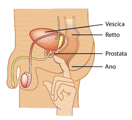 ipertrofia prostatica, tumore alla prostata 