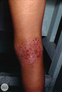 eczema surinfecte