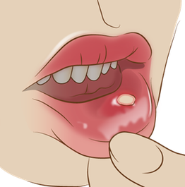 痛い口内炎