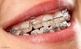 Festsitzende Zahnspangen für die kieferorthopädische Zahnregulierung (© proDente e.V.)