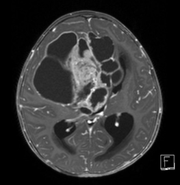 Primitive neuroectodermal tumor T1 with contrast