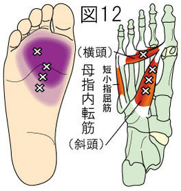 母指内転筋トリガーポイントによる足の痛み