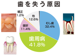 八戸市の歯科くぼた歯科　虫歯、歯周病