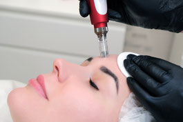 Microneedling Behandlungen Basel 