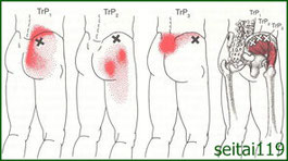 中臀筋トリガーポイント