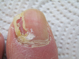 Nagelpilz vor einer Behandlung, der Fußnagelpilz ist erkannt worden