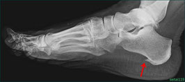 足底筋膜炎の原因の一つ「踵骨棘」