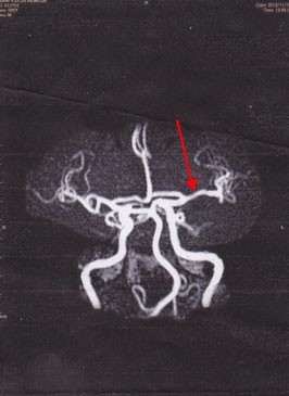 K脳神経外科のMRA画像