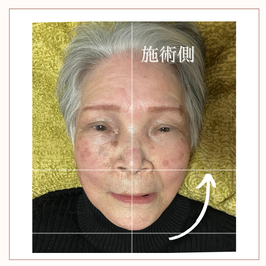 小顔ハイフ　ビフォーアフター